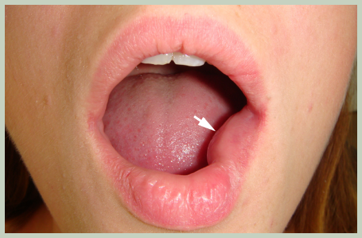 점액 낭종 원인