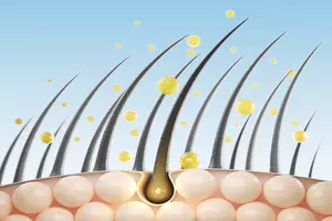 비절개-모발이식-비용