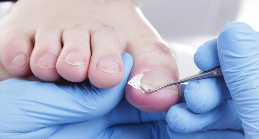 [Q&amp;A] 내성발톱 원인과 초기증상, 치료기간, 치료방법, 예방법