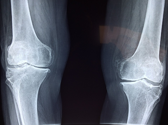 류마티스 관절염 증상