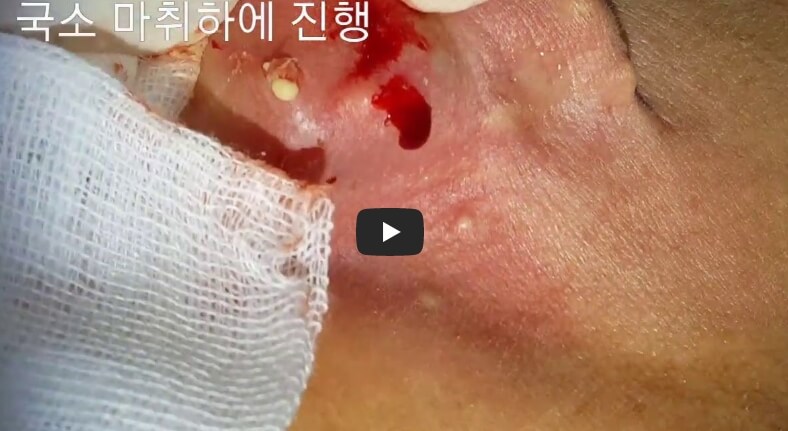피지낭종 수술 모습입니다
