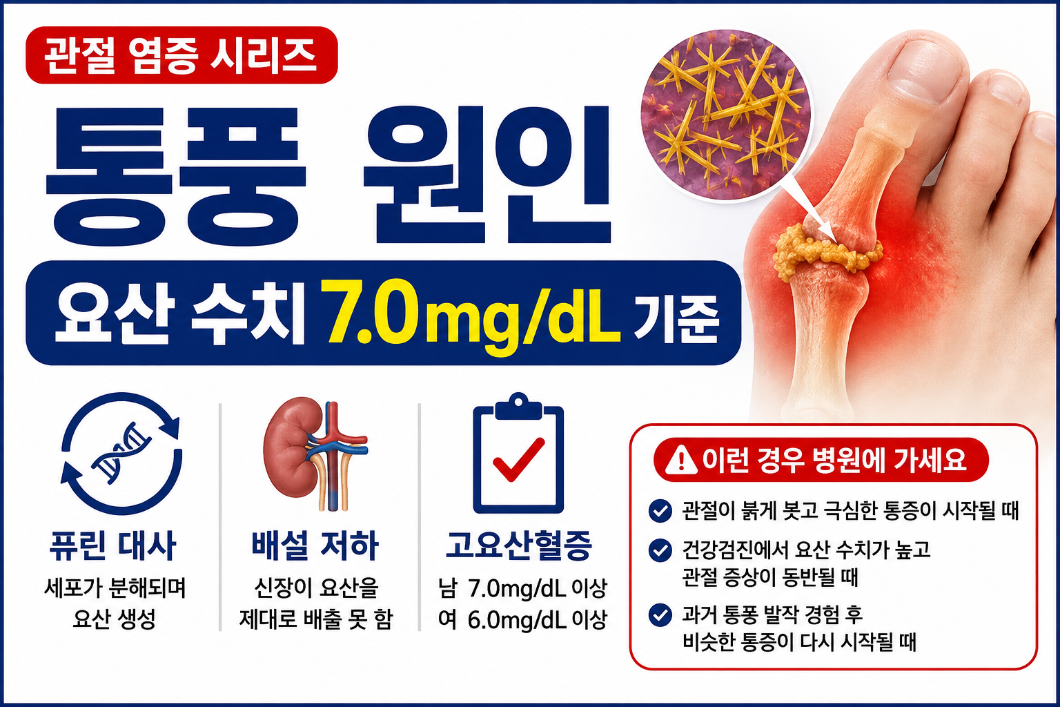 통풍 원인, 요산 수치 7.0mg/dL 기준