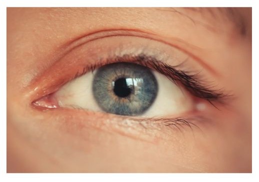 길버트 증후군 증상 황달 증상