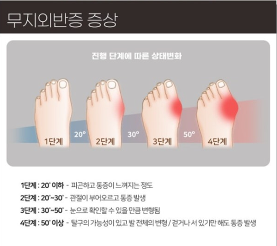 무지외반증 증상 관련 이미지