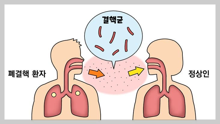 결핵이란