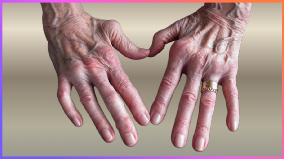 류마티스 관절염으로 인해 손가락 관절이 변형된 모습