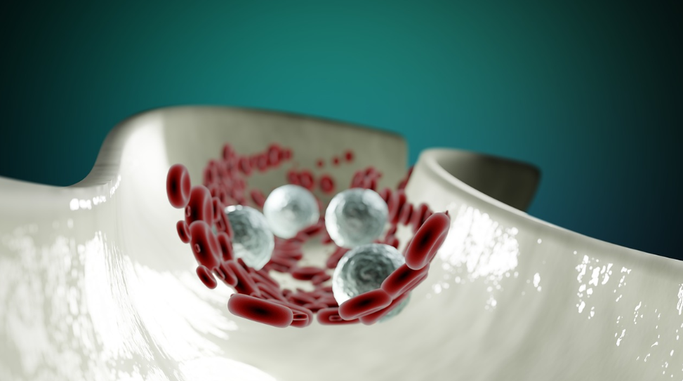 동맥경화, 혈관 관련 사진