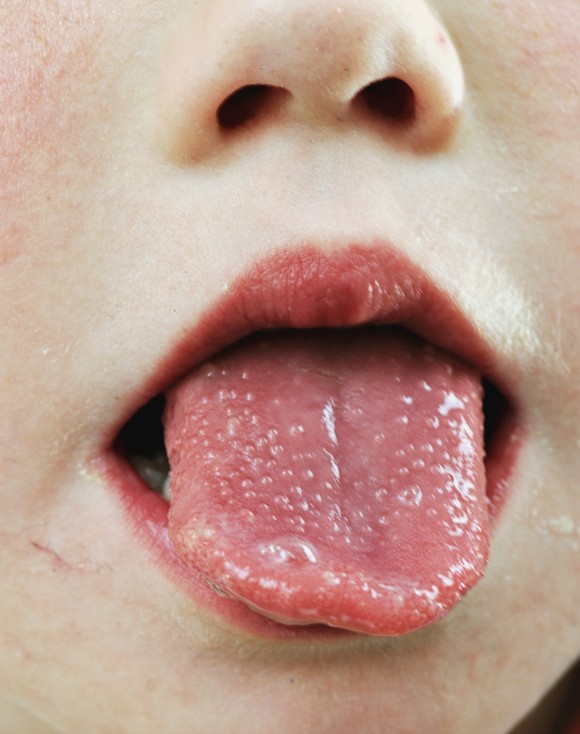 혓바늘이 돋는 이유 원인과 혓바늘 없애는 방법 꿀 치료법 자주돋는 현상