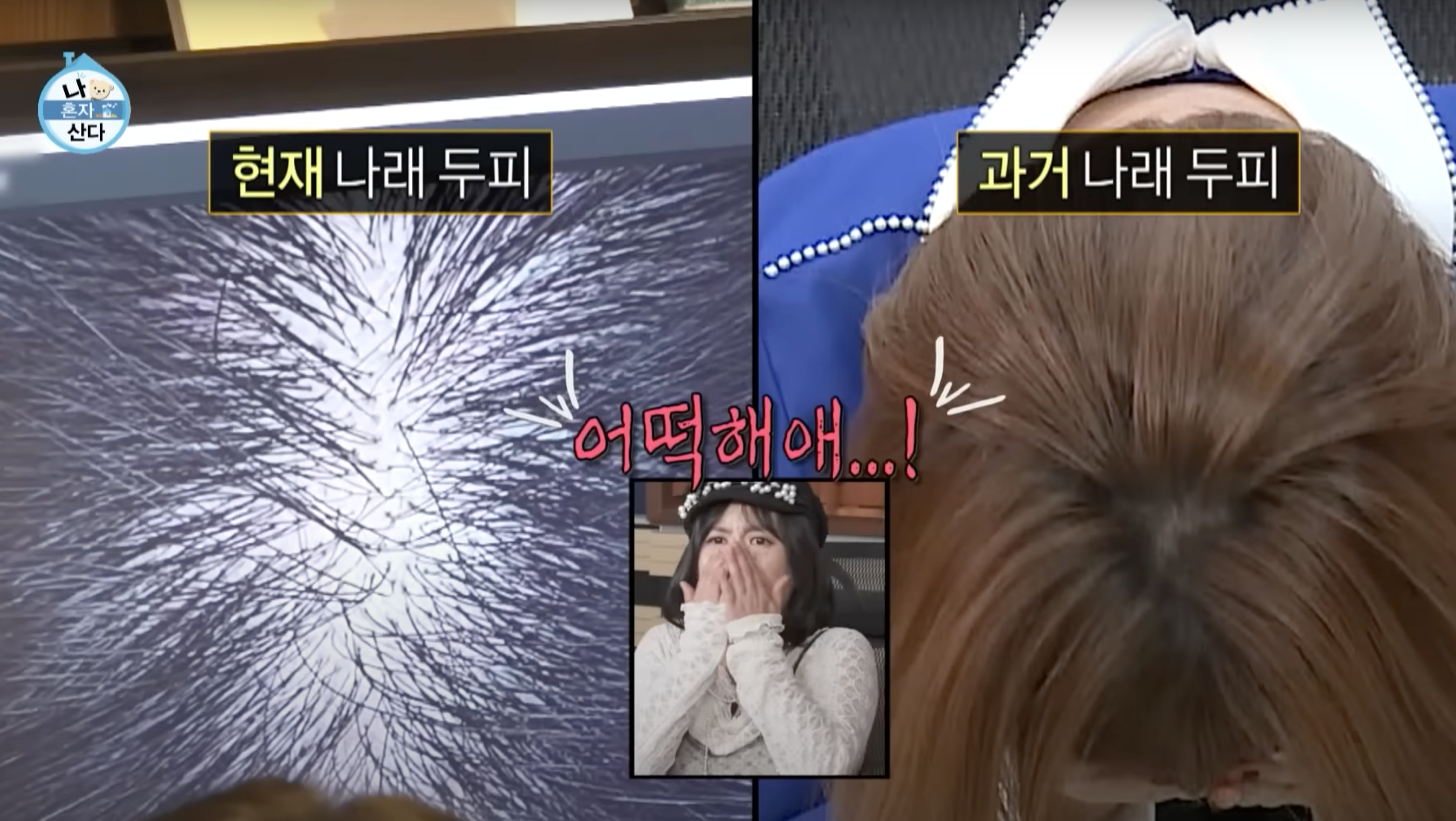 박나래탈모 나혼자산다 MBC