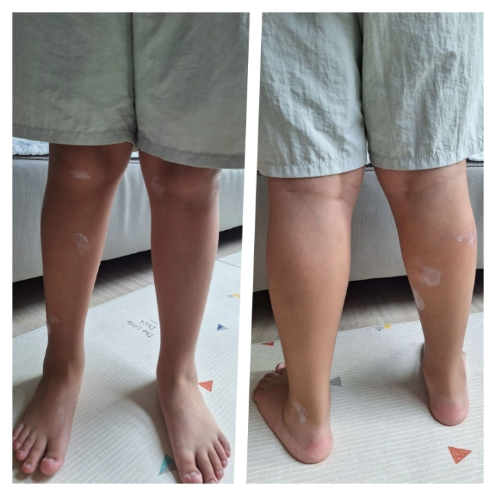 모기-물렸을-때-연고바르기