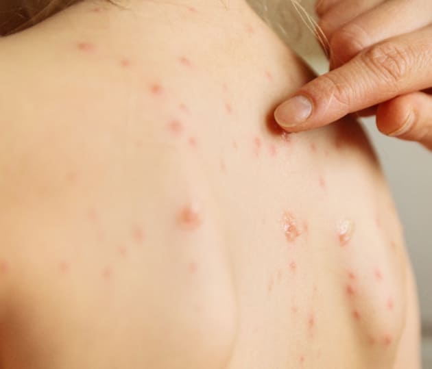 등에 대상포진 바이러스 감염 체크중