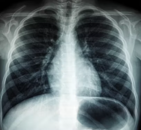 만성폐쇄성 폐질환 진단법 치료 합병증 관리