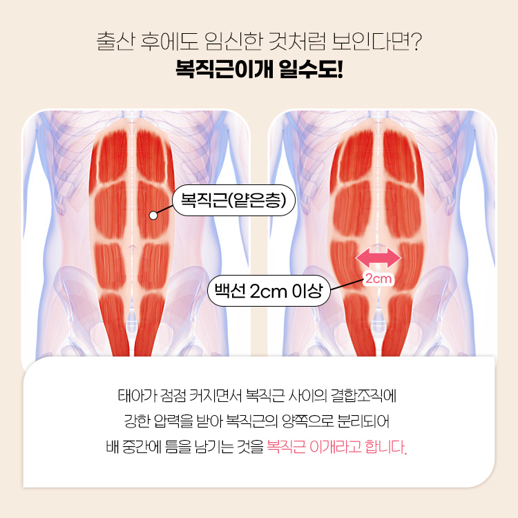 출산 후에도 임신한 것처럼 보이다면?
복직근이개 일수도!
