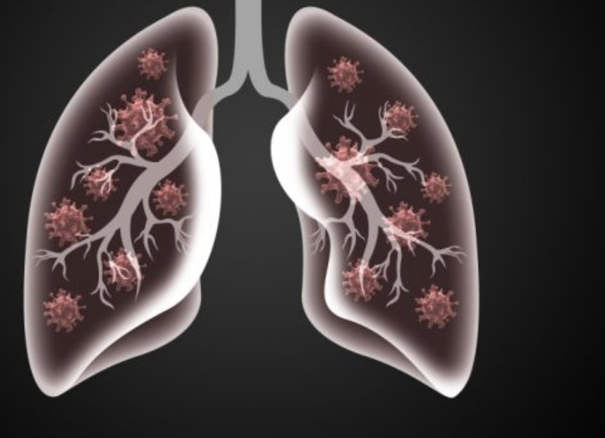 간유리음영 종류와 원인, 증상들