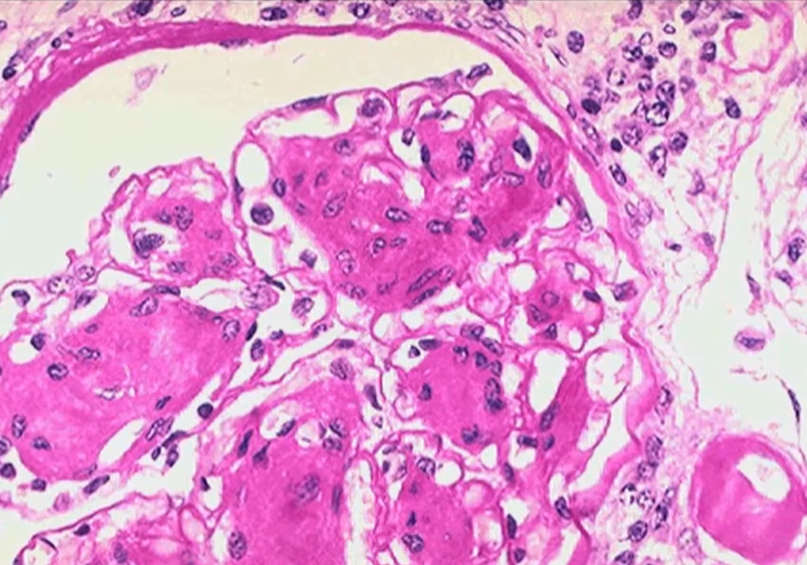 혈압 높을때 증상