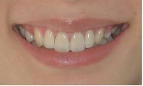 입안이 자주 허는 이유