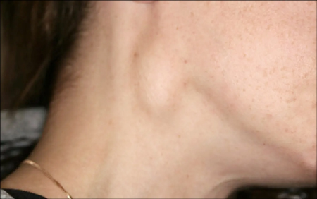 화이자 부작용 임파선염 부은모습 이미지