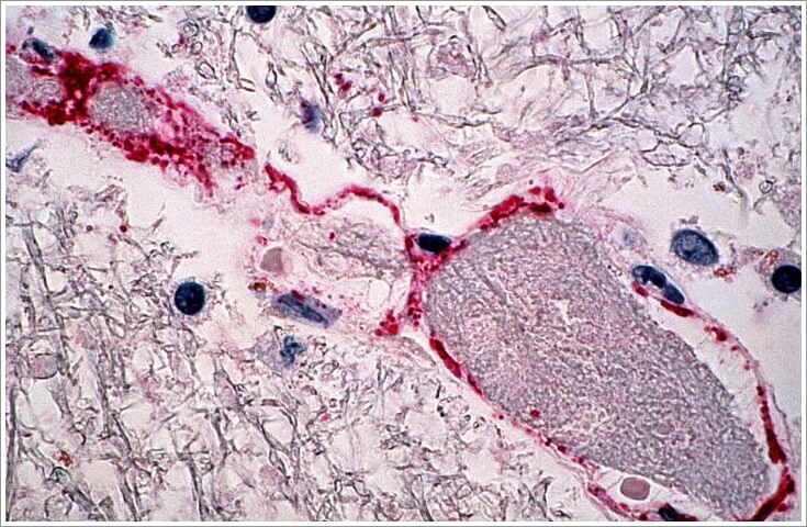 염증에 좋은 음식과 나쁜 음식