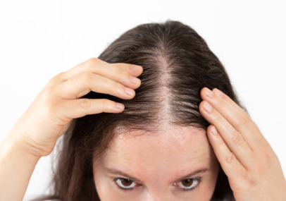 여성 탈모