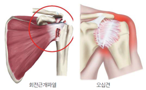 어깨가 아파요