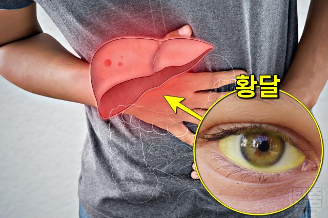 눈 흰자 노래요, 간이 안좋을때 증상 황달,팁줌