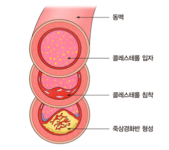 LDL 콜레스테롤 이미지