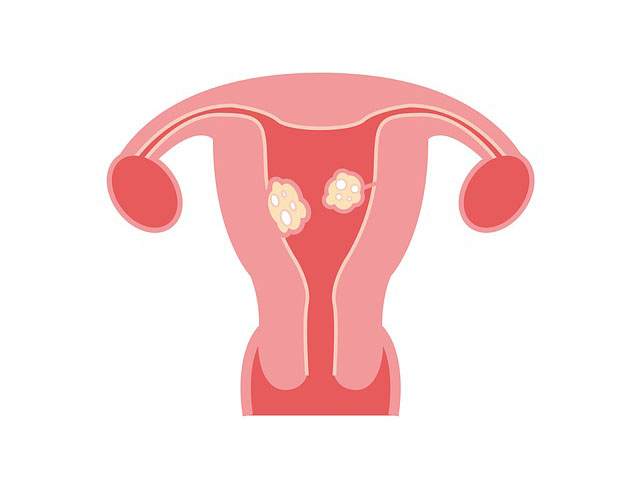 여자왼쪽아랫배통증원인 자궁내막증