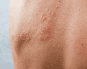 대상포진 예방접종 가격