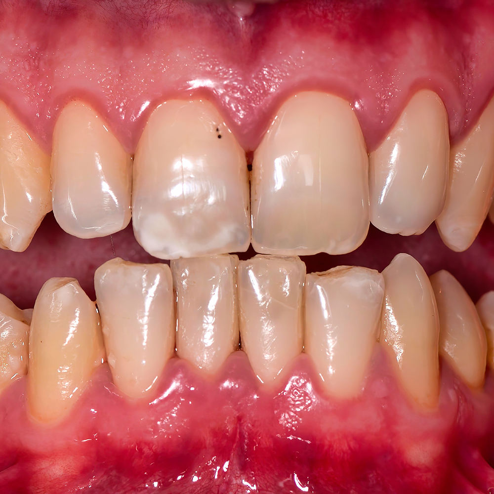 잇몸 부었을 때