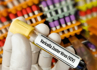 대상포진 예방접종 가격