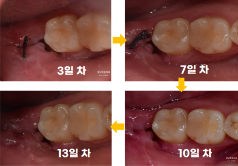 사랑니 발치후 식사와 음주