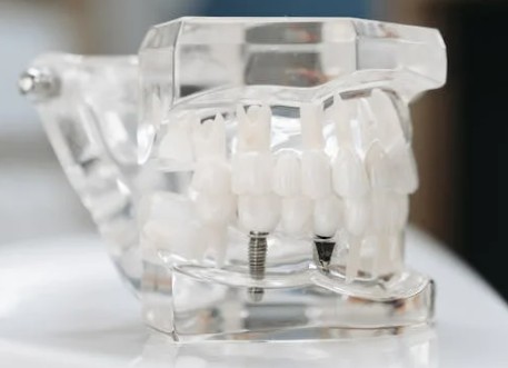 대전-중구-임플란트-치과-가격-비용-싼-곳,저렴한-곳,잘하는-곳,유명한-곳-BEST20-추천15