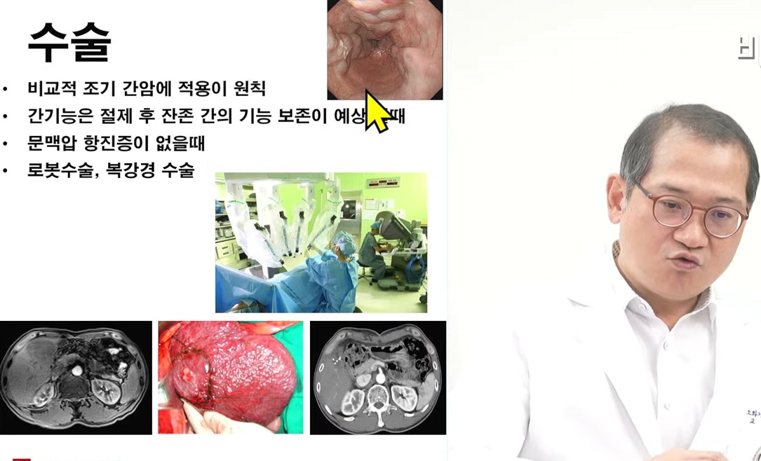 명의-지방간염-김지훈-교수-간암수술