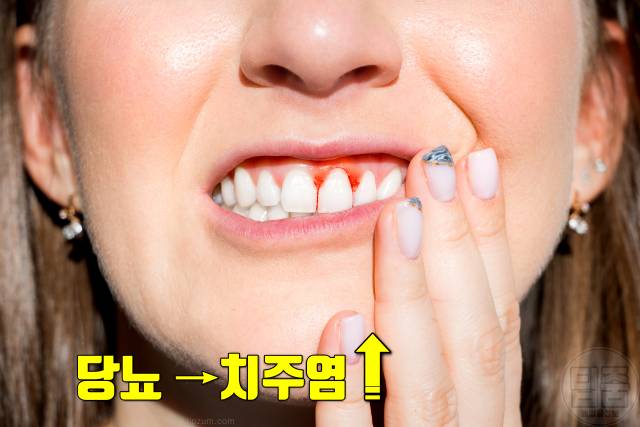 남자 당뇨 증상 특징 내분비내과 전문의 피셜 잇몸 피