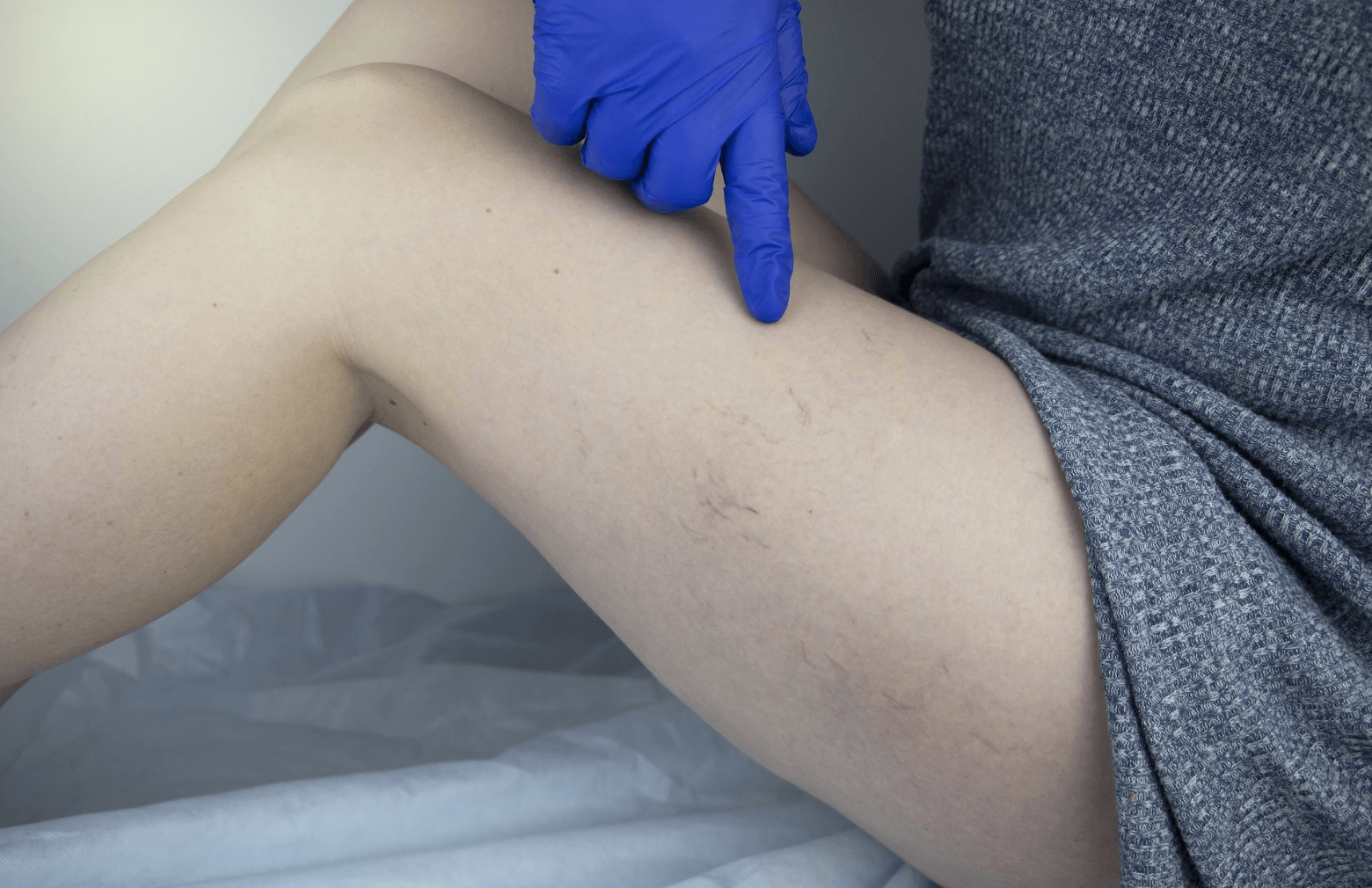 하지정맥류 원인