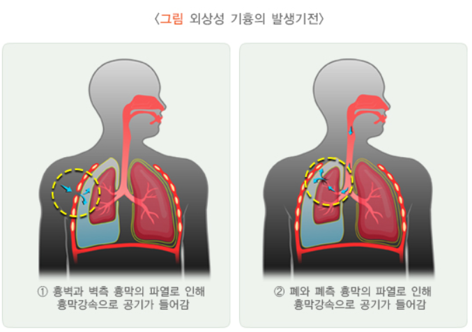 기흉에 대하여