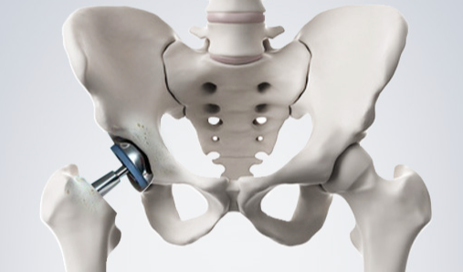 고관절의 인공관절