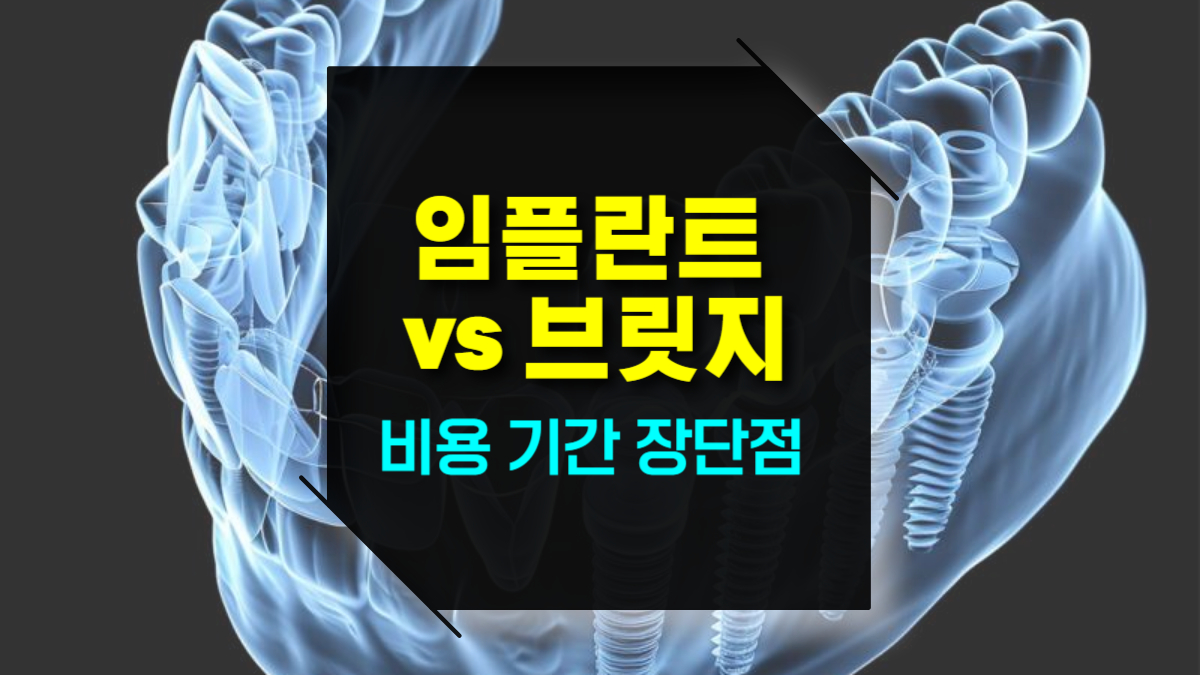 치과 임플란트 vs 브릿지 빠진 치아 치료법 비용 치료 기간 장단점 비교