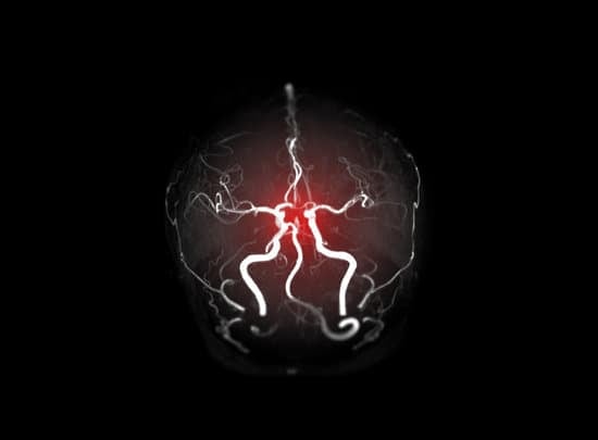 MRA(자기공명 혈관조영술)