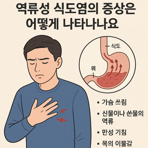 역류성 식도염의 증상
