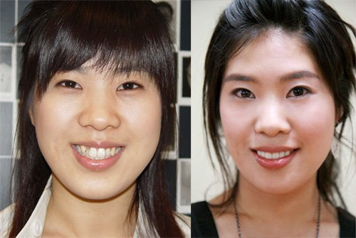 개그우먼 강유미 덧니 교정 