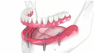 전체 임플란트 시술과정