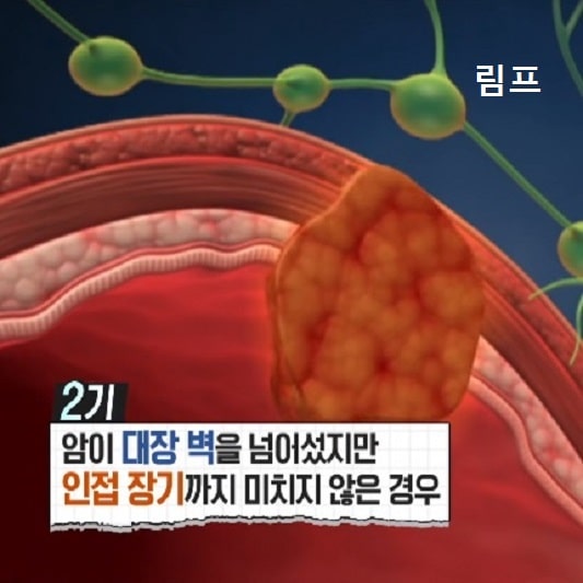 대장암 증상