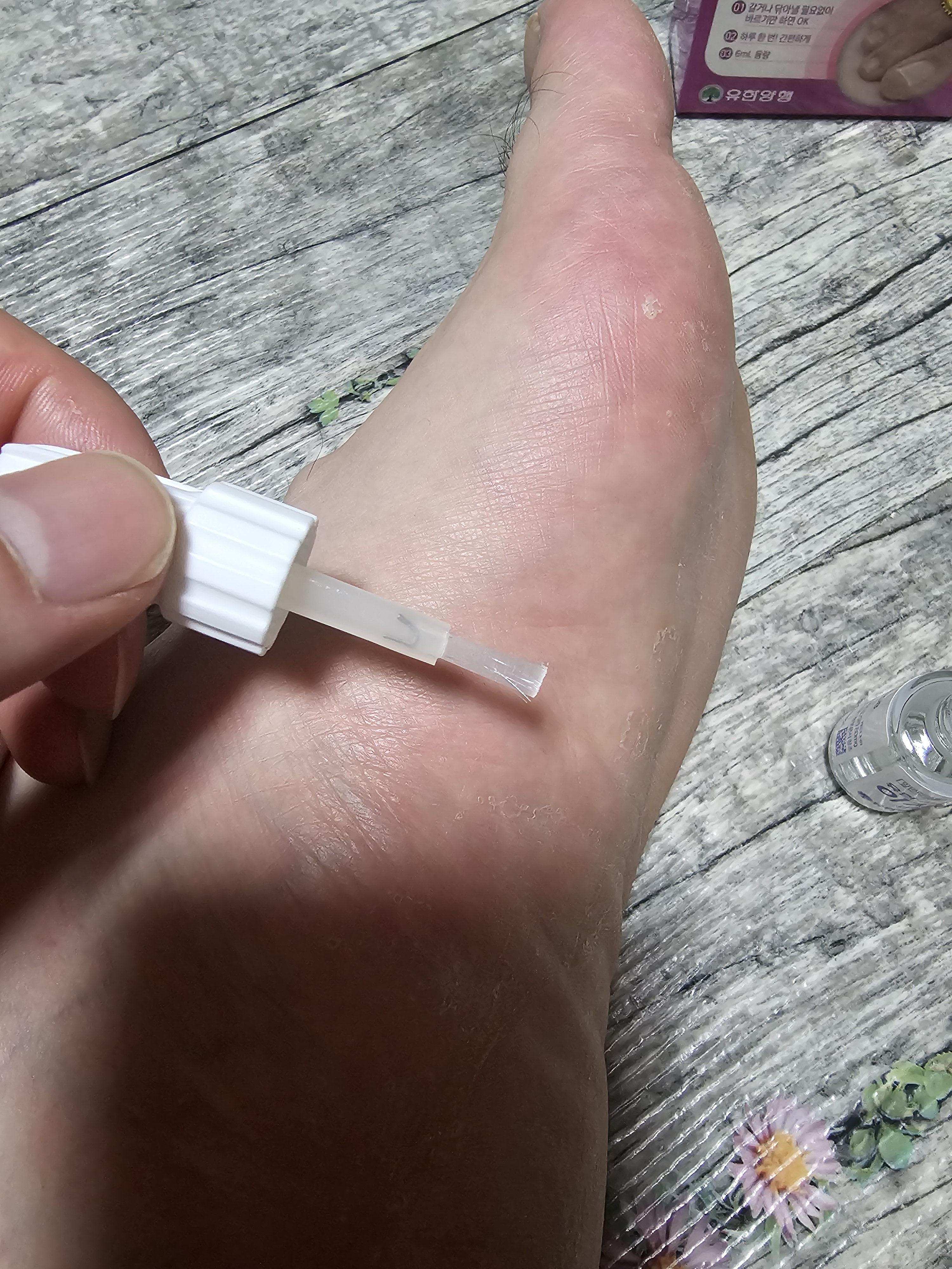 무좀 치료약 유한이지케어네일라카