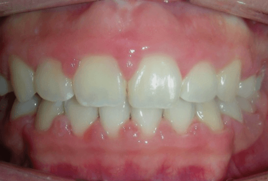 앞니-임플란트-사진입니다