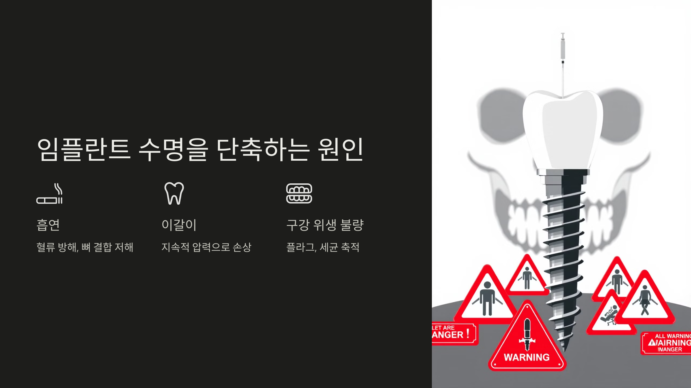 임플란트 수명을 단축하는 원인
