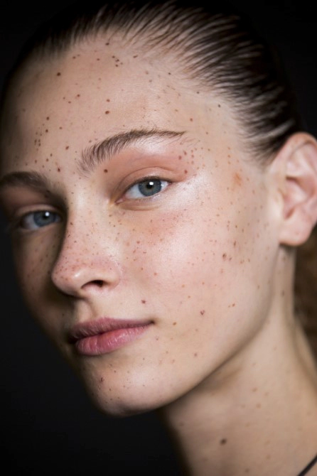 기미 없애는 방법