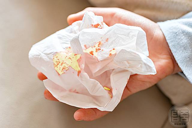 비인두암 증상 피 섞인 콧물 비염 증상