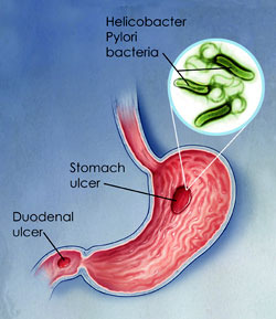 H. pylori