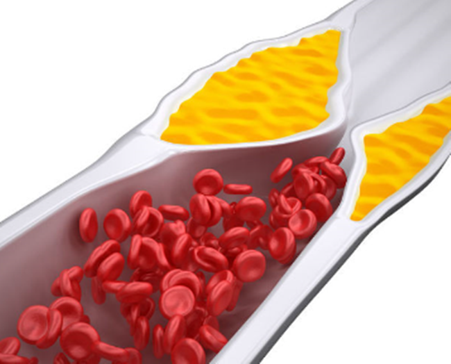 콜레스테롤 높으면 나타나는 증상